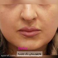 فیلم نتیجه هایفودرمانی تنها در یک جلسه