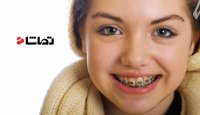 تاثیر ارتودنسی بر فرم بینی