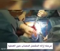 استبدال مفصل الحوض