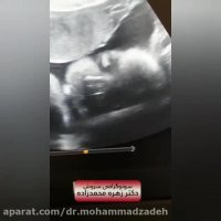 فیلم سونوگرافی جنین دختر در 31 هفتگی