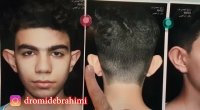 عمل اتوپلاستی توسط دکتر امید ابراهیمی