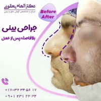 جراحی بینی در مردان