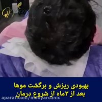 ️بهبودی ریزش و برگشت موها بعد از 3ماه از شروع درمان️