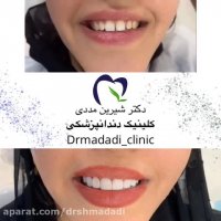 8 واحد ونیر کامپوزیت فک بالا توسط دکتر شیرین مددی