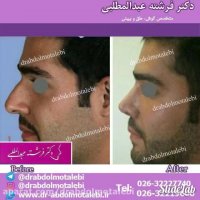 عمل زیبایی بینی