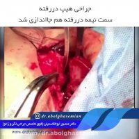 دررفتگی مادرزادی در هیپ