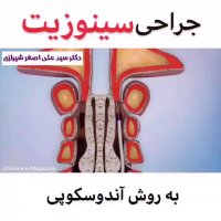 جراحی سینوزیت