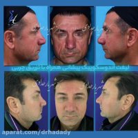 لیفت اندوسکوپیک پیشانی با تزریق چربی