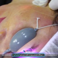 رفع غبغب و افتادگی پوست با اندولیفت - 02632402304