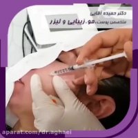 مزوتراپی صورت