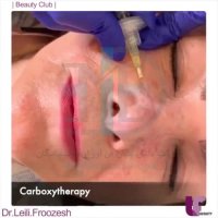 کربوکسی تراپی در کلینیک دکتر فروزش ( پارت 2 )