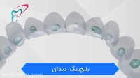 بلیچینگ دندان