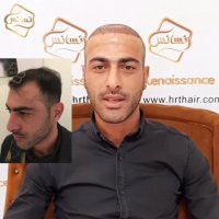 کاشت مو به روشSUT -کلینیک تخصصی رنسانس