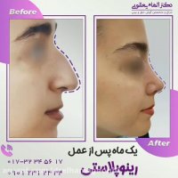 یکماه بعد از جراحی رینوپلاستی