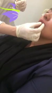 فیلم تزریق ژل لب