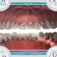 ارتودنسی لینگوال | دندانپزشکی سیمادنت