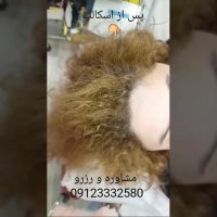 اسکالپ راه حلی قطعی برای رفع کم پشتی موی خانمها