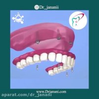 پروتز متکی بر ایمپلنت با اوردنچر