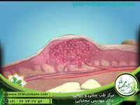 زگیل چگونه جایگزین می شود؟ | طب سنتی