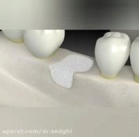 فیلم بازسازی استخوان فک برای انجام ایمپلنت 2