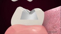 پرکردن دندان