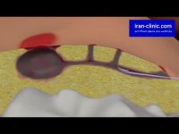 درمان فیستول با لیزر و جراحی بدون بازگشت در ایران کلینیک