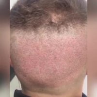 فیلم کاشت مو_کلینیک تخصصی رنسانس