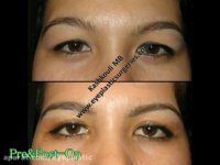 نمونه های جراحی کانتوپلاستی | پروفسور کشکولی