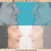 جراحی بینی استخوانی