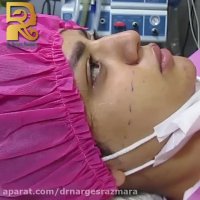 جراحی بینی استخوانی به روش باز