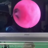 اصلاح تنگی ناحیه ساب گلوت