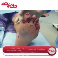 پیشگیری از تاول دیابتی