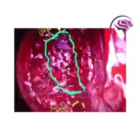 ترمیم اندوسکوپی انسفالوس اتموئیدی فوا( traumatic encephalocele)