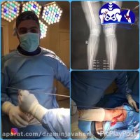 جراحی استئوتومی زانوی ضربدری