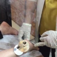 درمان ورم مفصل پاشنه پا با طب سوزنی | 22885090