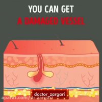 عدم استفاده از موچین برای کندن موهای بینی