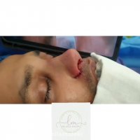 فیلم جراحی بینی مدل نیمه فانتزی مردانه