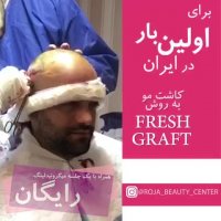 کاشت مو با روش Fresh Graft