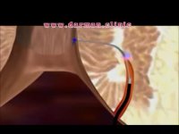 درمان فیستول با لیزر - درمان کلینیک