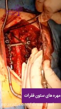 درمان تنگی شدید کانال کمری و جابجایی مهره های ستون فقرات