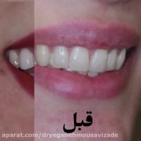 فیلم کامل ونیر کامپوزیت