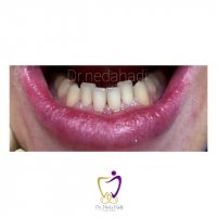 اصلاح بهم ریختگی های فک پایین