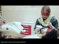 تفاوت لمینیت با بلیچینگ و کامپوزیت ونیر