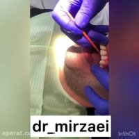 مراحل گذاشتن کامپوزیت