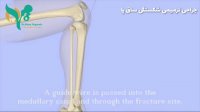 انیمیشن چگونگی جراحی ترمیمی شکستگی ساق پا