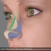 جراحی ترمیمی بینی